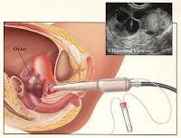 Egg Procedure