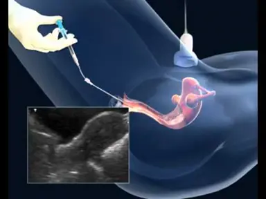 Healthy Embryo Injection