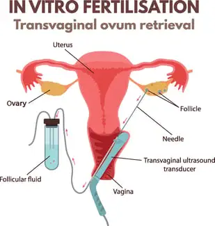 Transvaginal Ovum Retrieval